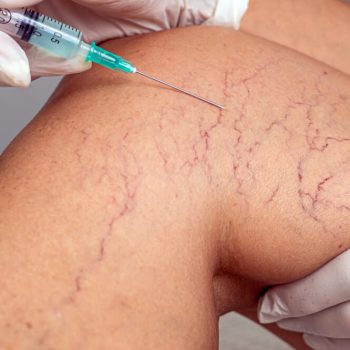Sclerotherapy